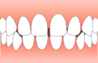 すきっ歯で悩んでいる